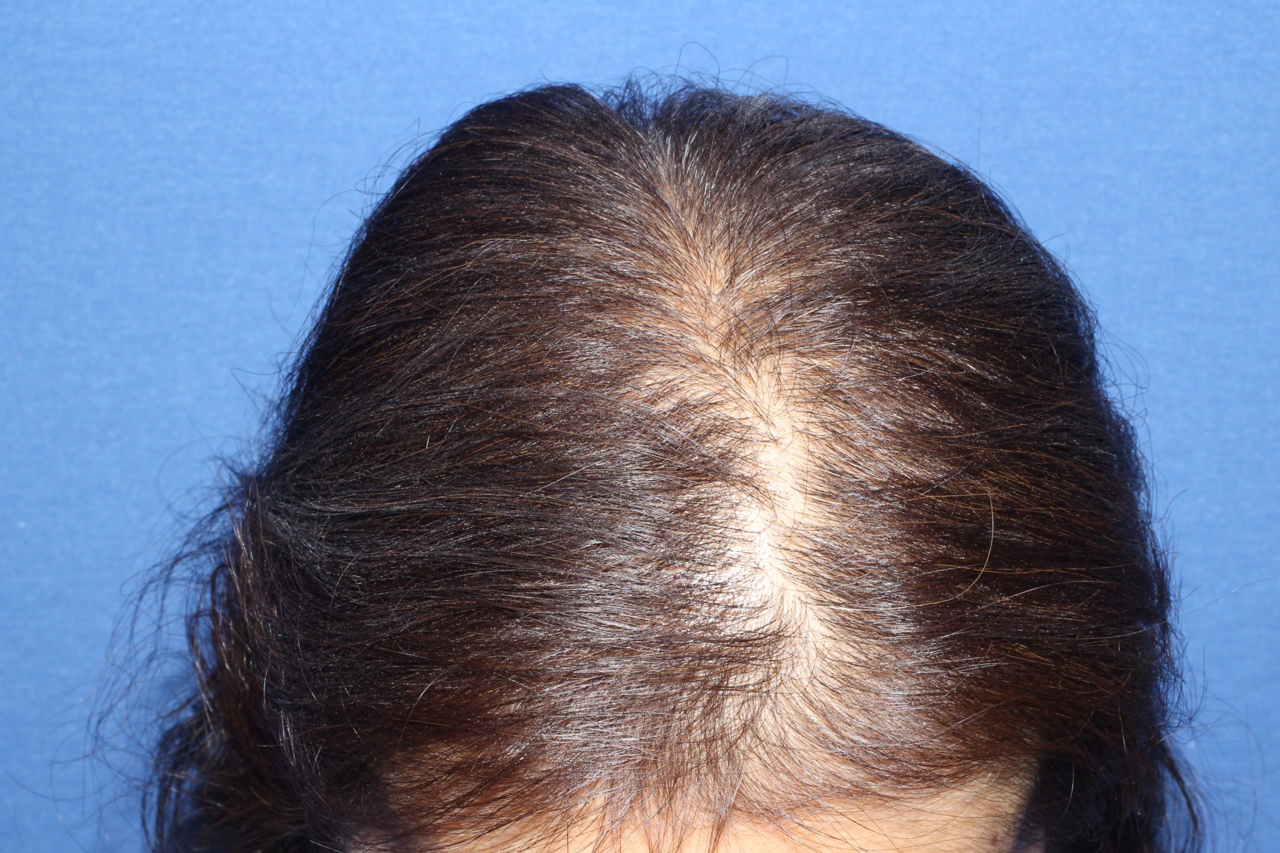 頭頂部の植毛について 女性の自毛植毛 親和クリニック
